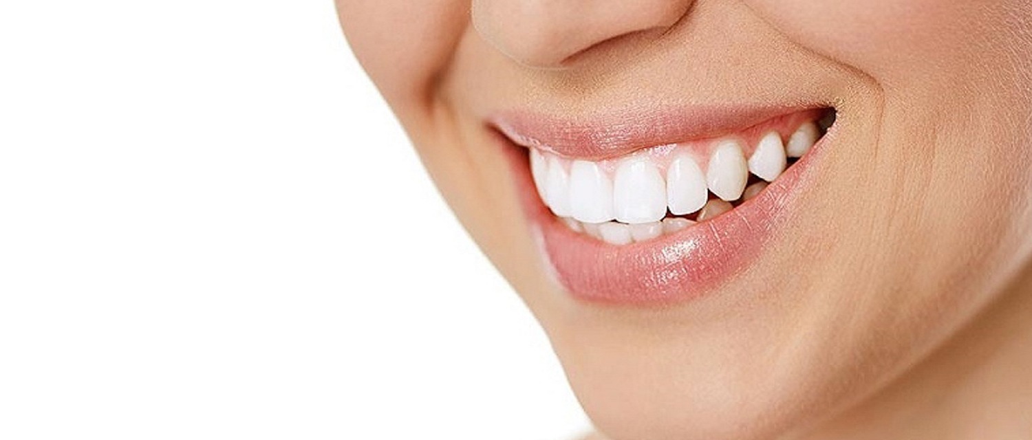 Porcelain Veneers Schultz Family Dental